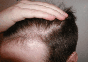 Adiós Calvicie: Consejos Chas