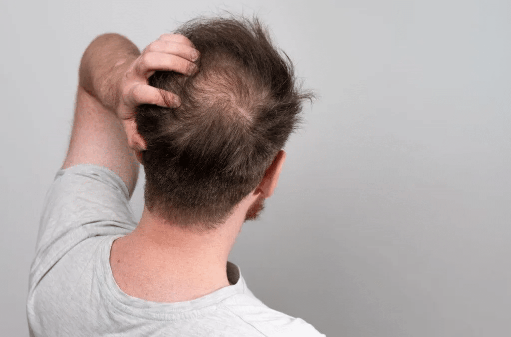 REDUCIR LA PÉRDIDA DE CABELLO